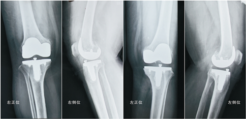 C:\Documents and Settings\Administrator\桌面\4、术后X片示：双侧膝关节假体位置良好，膝内翻畸形得到矫正_副本.jpg