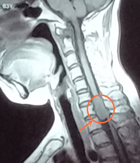 术前平扫MR（C6-T1）脊髓肿瘤_副本.jpg
