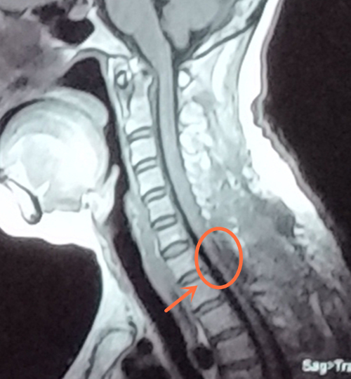 术后平扫MR显示：（C6-T1）段脊髓肿瘤全切_副本.jpg